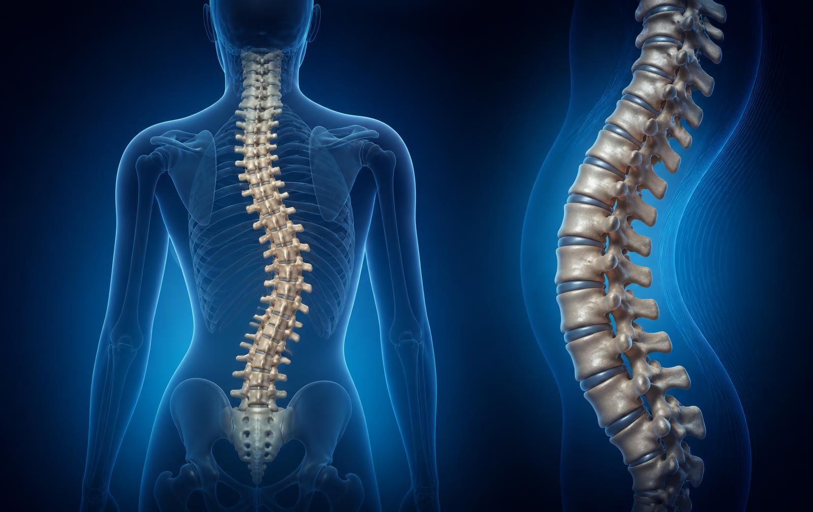 Anatomical illustration of a spine with a scoliotic curve